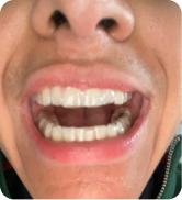 Smile Step 3