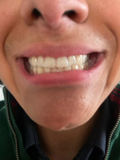 Smile Step 1