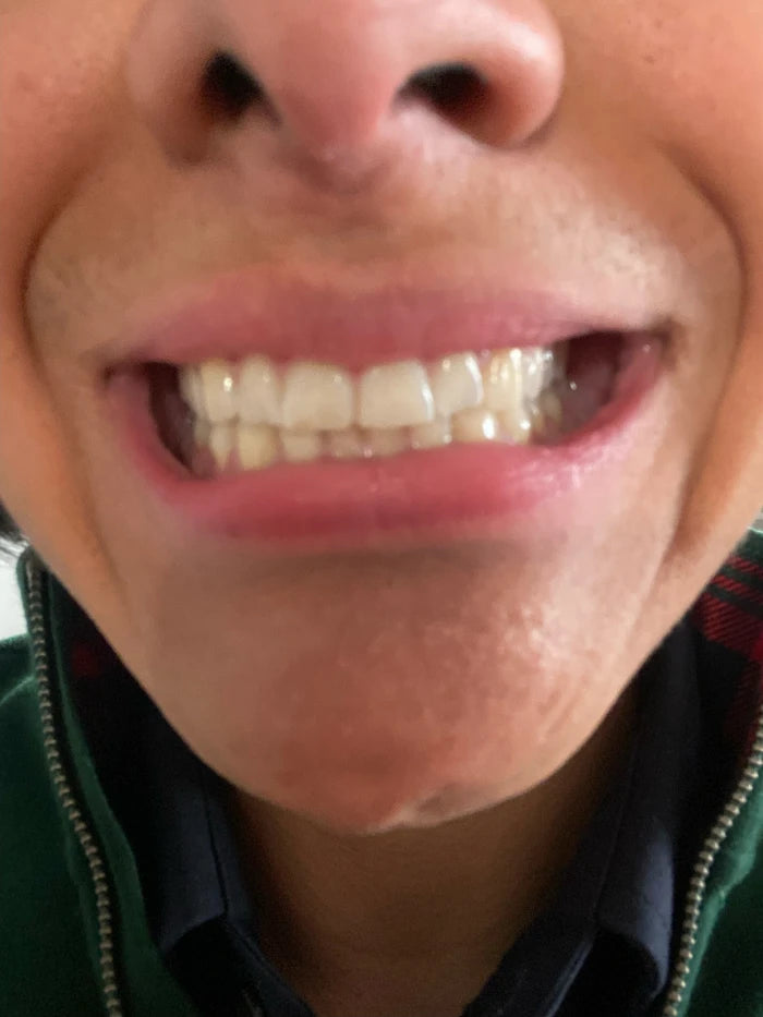 Alexander Kiessling’s 6-Month Smile Transformation with ALIGNERCO