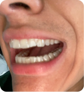 Alexander Kiessling’s 6-Month Smile Transformation with ALIGNERCO