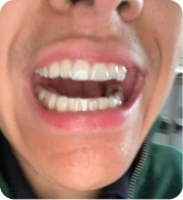 Alexander Kiessling’s 6-Month Smile Transformation with ALIGNERCO