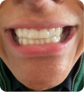 Alexander Kiessling’s 6-Month Smile Transformation with ALIGNERCO