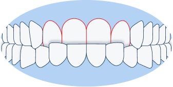 Anterior Crossbite: