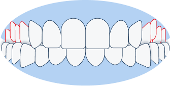 Buccal Crossbite: