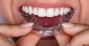 ALIGNERCO Announces New Offers on Clear Aligners for Teeth Straightening
