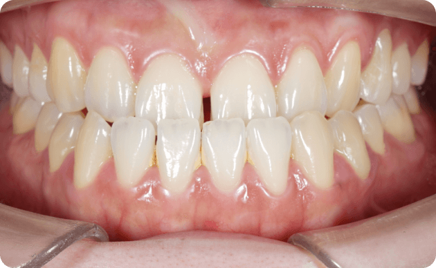 What Is A Crossbite?