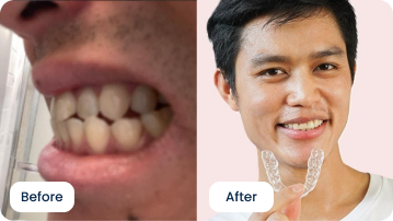 Daniel Chang Recommends ALIGNERCO for All Teeth Issues