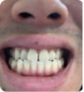 Smile Step 1