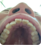 Smile Step 2