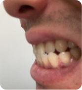 Smile Step 3
