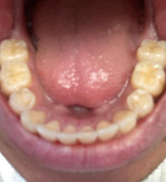 Smile Step 4