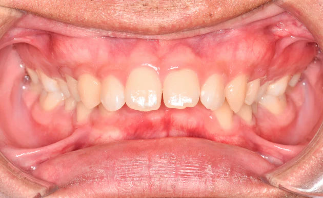 What Will Happen If It's Left Untreated?