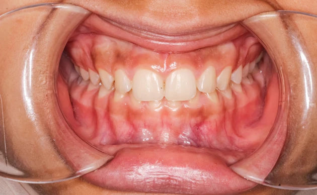 What Is A Deep Bite?