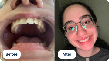 Devorah Leah Popper Gets a Beautiful Smile with ALIGNERCO