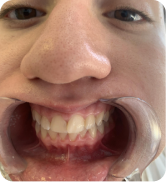 Smile Step 1