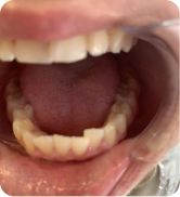 Devorah Leah Popper Gets a Beautiful Smile with ALIGNERCO