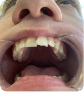 Devorah Leah Popper Gets a Beautiful Smile with ALIGNERCO