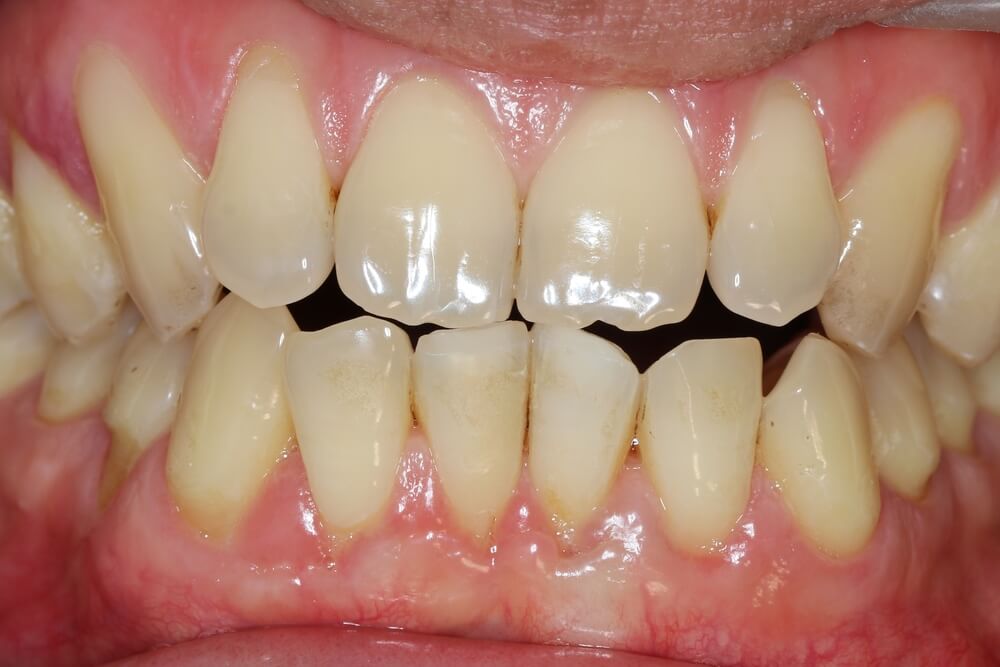 What Is An Edge To Edge Bite?