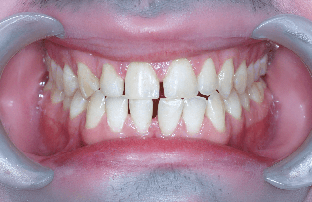 What Will Happen If It's Left Untreated?