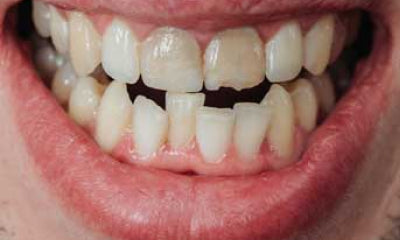 Causing damage to other teeth