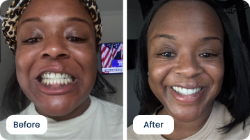 Letesia Pool’s Happy Ongoing Teeth Straightening Journey with ALIGNERCO
