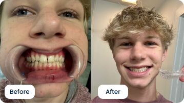 Matt Upton Thanks ALIGNERCO for an Easy Teeth Straightening Journey