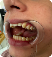 Smile Step 1
