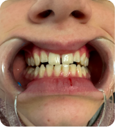 Smile Step 2