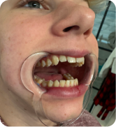 Smile Step 3