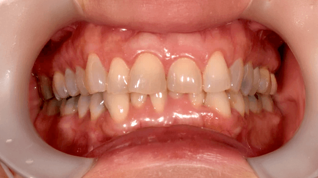 What Will Happen If It's Left Untreated?