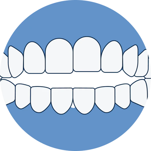 Open bite