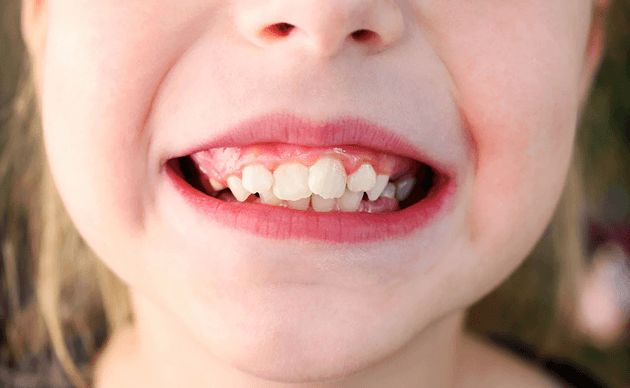 What Happens When An Overbite Is Left Untreated?