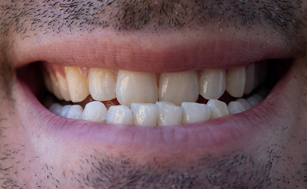 What Is An Underbite?