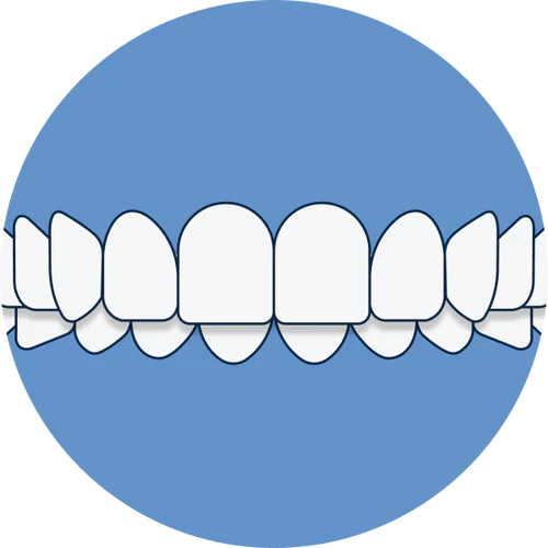 Overbite