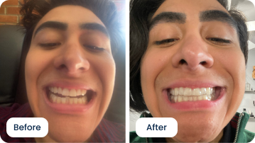 Alexander Kiessling’s 6-Month Smile Transformation with ALIGNERCO