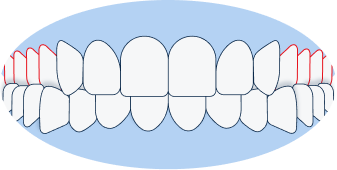 Posterior Crossbite: