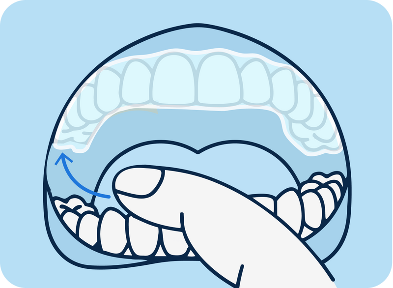 Gently lift from a back molar on one side, then the other