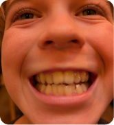 Smile Step 1