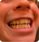 Smile Step 2