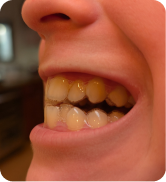 Smile Step 3