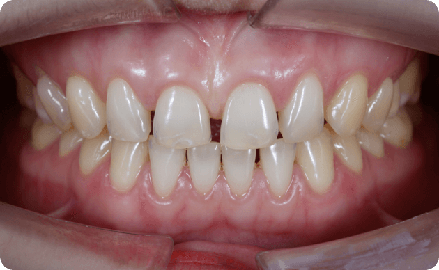 What is Teeth Spacing?