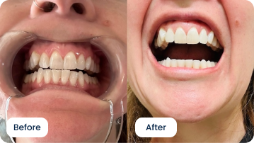 Teresa Murtha Realigns Protruding Teeth with ALIGNERCO