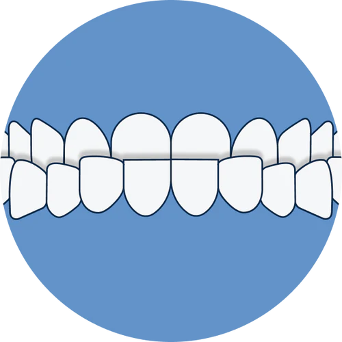 Underbite