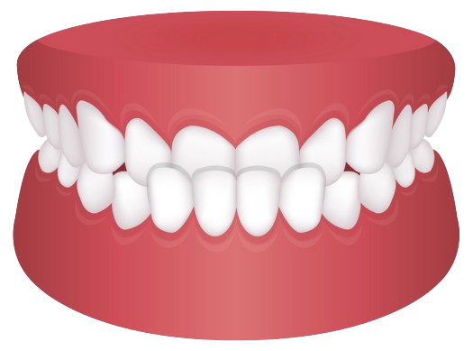 Fix Your Underbite With ALIGNERCO