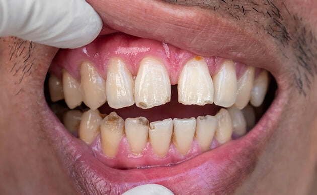 What Will Happen If It's Left Untreated?
