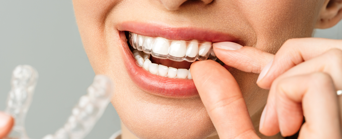 How to Care for Your Aligners
